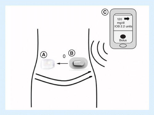 Review of the Omnipod® 5 Automated Glucose Control System Powered by  Horizon™ for the treatment of Type 1 diabetes | Therapeutic Delivery